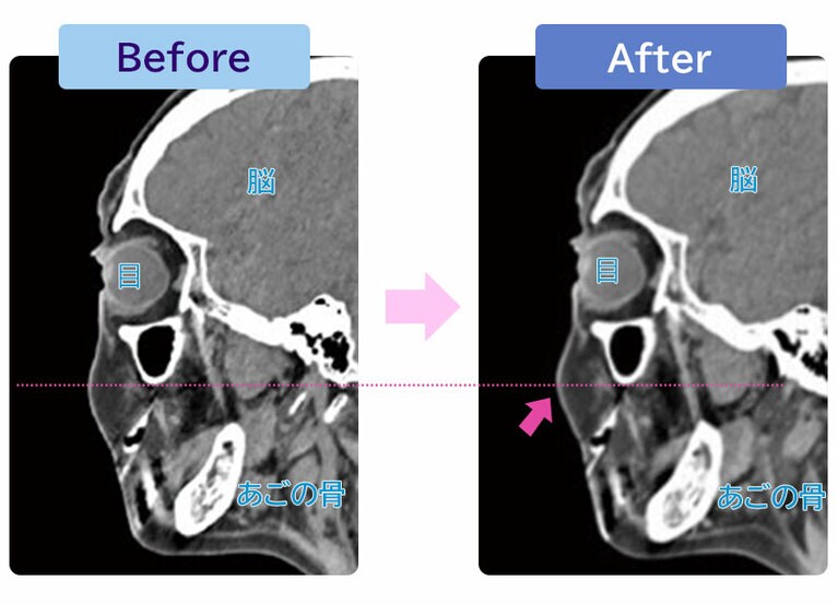 60代女性のCT画像。ビフォー（左）と比べて、表情筋エクササイズを続けた後のアフター（右）は、頬の位置が上がり、厚みも増している。