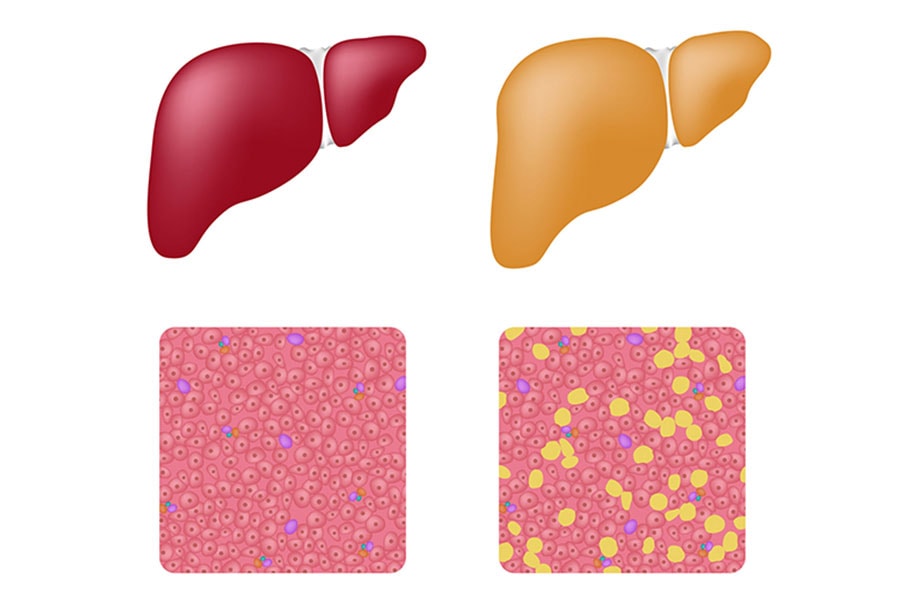 普通の肝臓と脂肪肝の肝臓。右の図の黄色い塊が脂肪です。