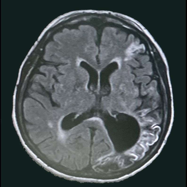 実際の脳のMRI画像。中央に黒い空洞が……