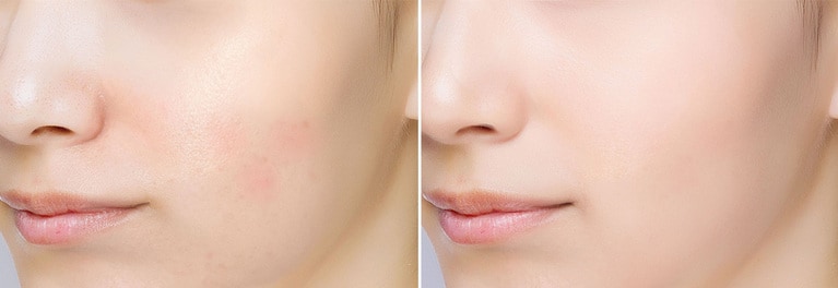 左が塗る前、右が塗った後。赤みやくすみ、黒ずみなどの色のトラブル、毛穴やニキビ跡などの肌表面の凹凸の両方をキレイにカバーしてくれる。