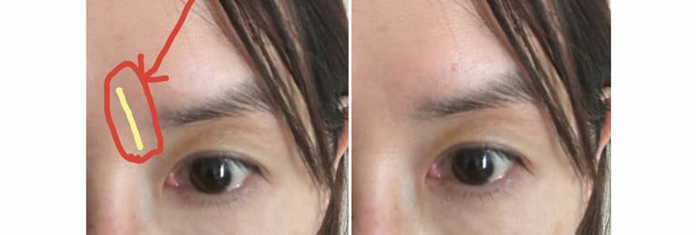 使用前。眉間に縦ジワが深く長く刻まれています。