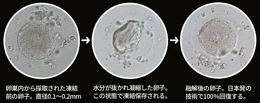 写真提供：オーク住吉産婦人科
左から：卵巣内から採取された凍結前の卵子。直径0.1～0.2mm／水分が抜かれ凝縮した卵子。この状態で凍結保存される。／融解後の卵子。日本発の技術で100％回復する。