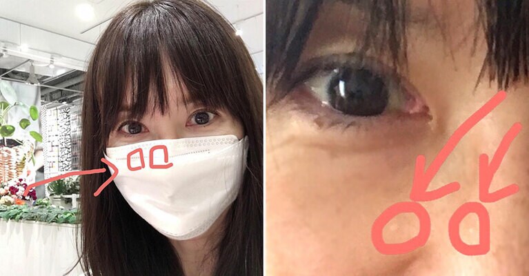 マスクのワイヤーが当たる場所にできたポツポツ。中でも、鼻横のモノがどんどん大きくなって邪魔でした。