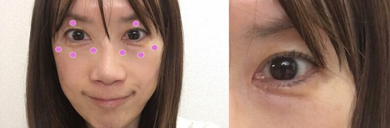 右が伸ばした状態です。伸びるので「ゴマ1粒程度の量×4」でまずはここまでカバー！