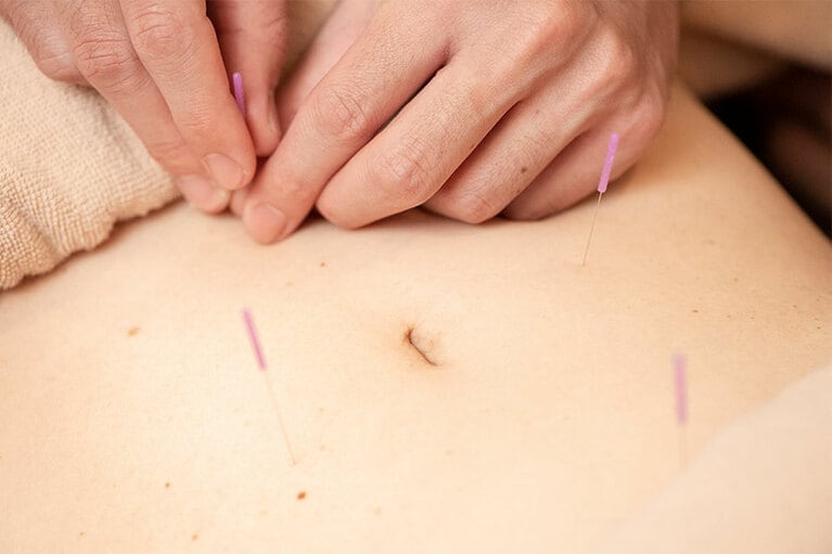 おなかの4カ所に鍼を打たれると空腹感を感じなくなるから不思議だ。