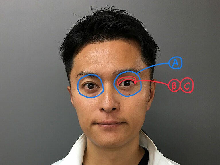 Aが眼輪筋。まぶたの奥にあるのが、眼瞼挙筋とミューラー筋(B・C)。