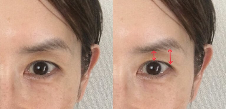 1回目の使用からスッキリが叶いました。むくみが取れて、眉下が早くも短くなり、角度も平行に近づいています。