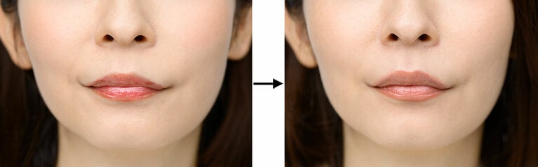 写真左から、BERORE画像、AFTER画像。