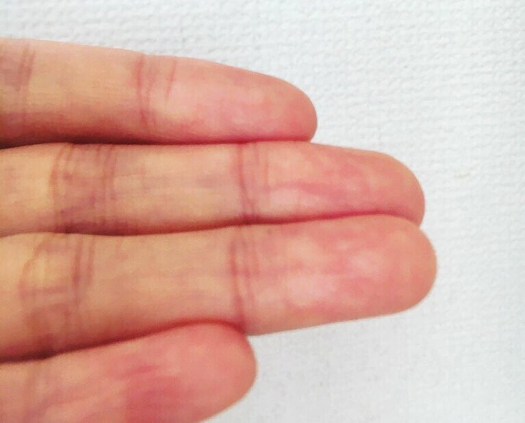 2日後には相当改善しました。