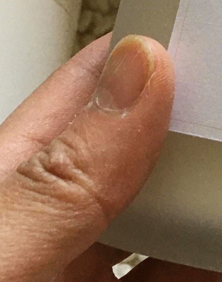 記事に使うための写真を撮った時の指です。指先のひび割れが隠せないほどでした。