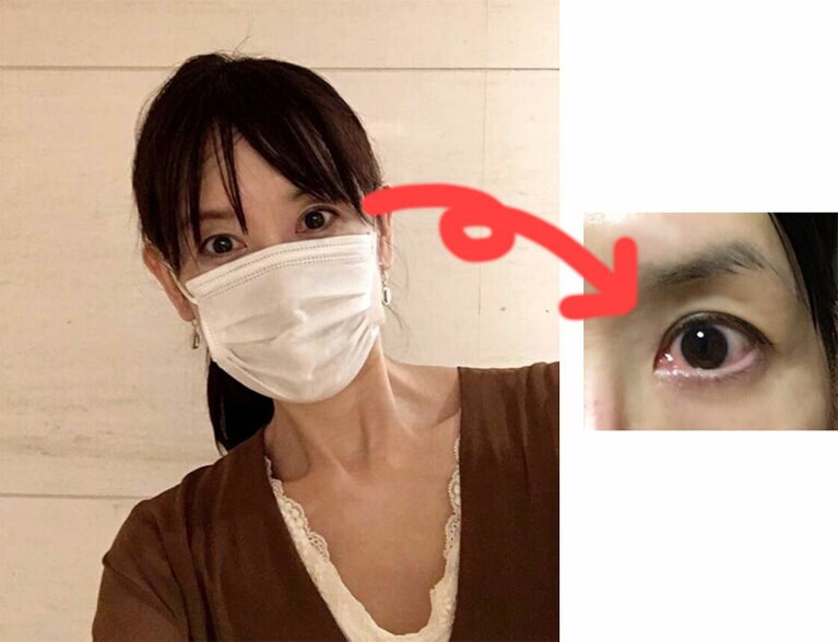 PC使用後は目が疲れるので、クマが濃くなるのはもちろん、なぜか目が小さくなります(左写真参照)。さらに、充血することも……。