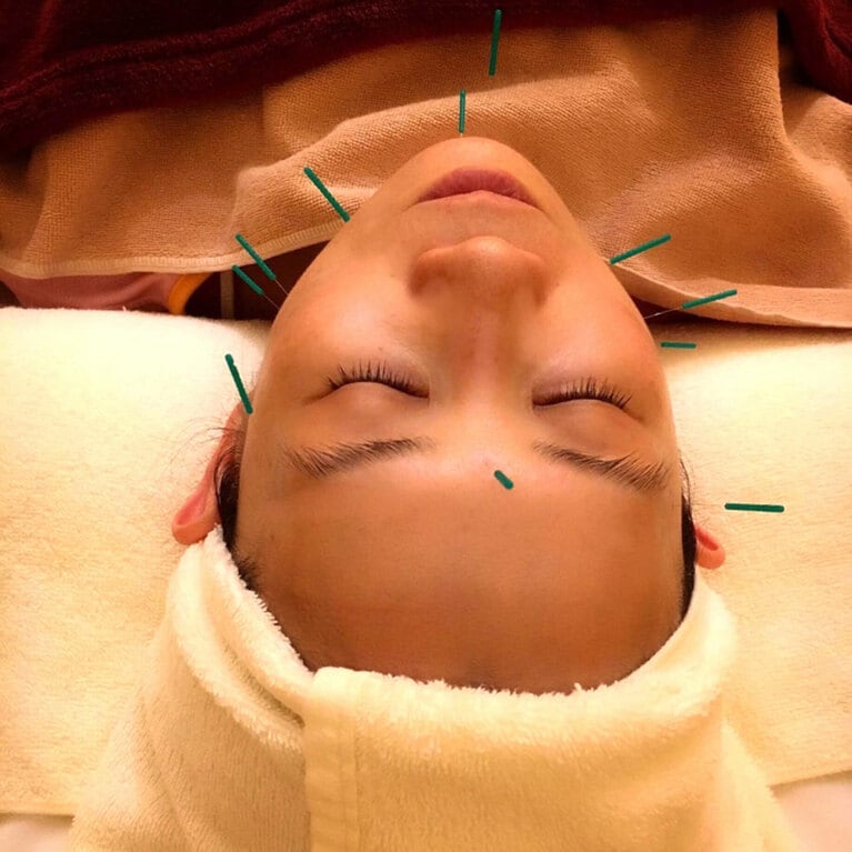 美容鍼中のにらさわ。その時々で鍼を置く場所が異なるのですが、この時は頬のたるみを気にしていたと思われます。