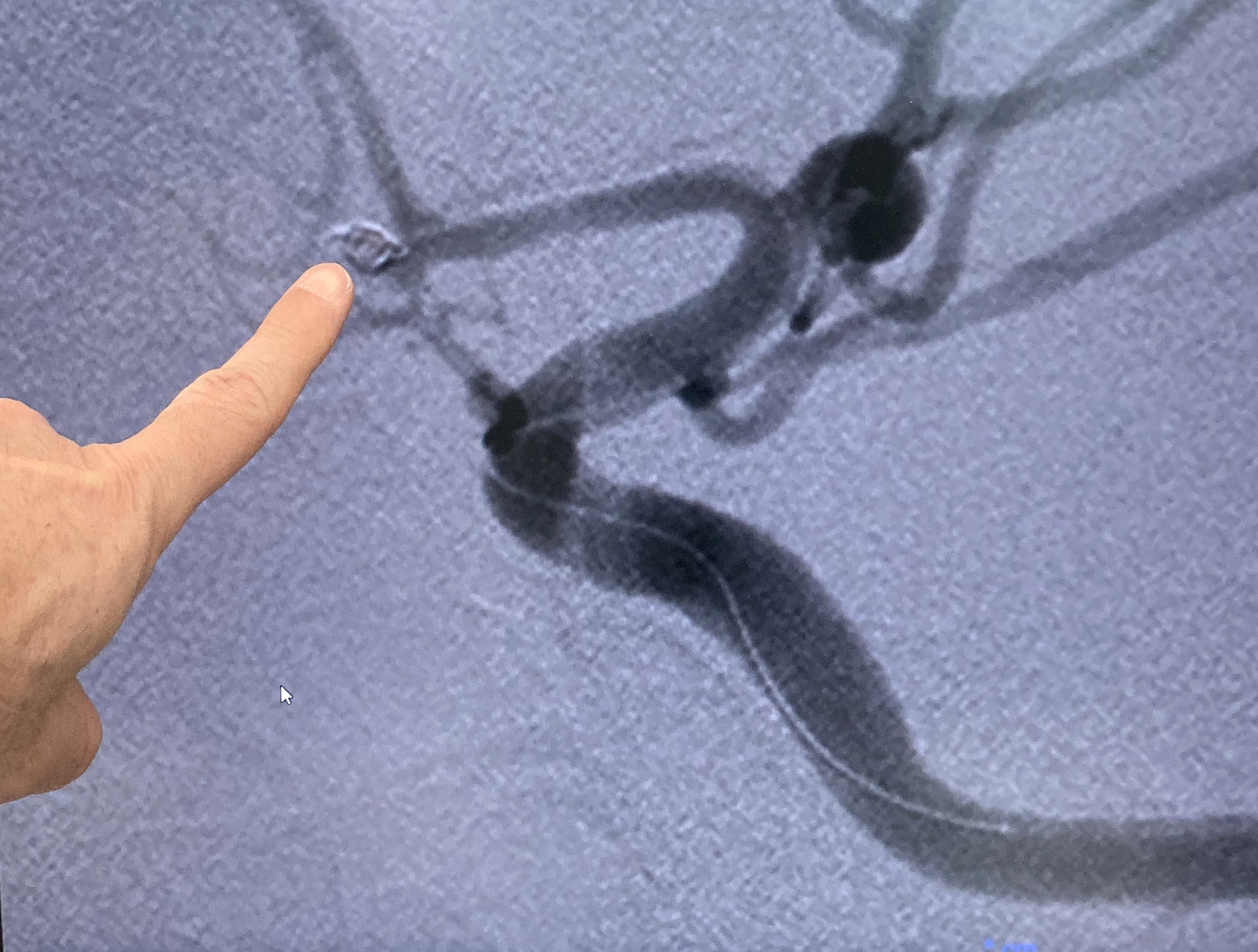 清水さんの脳のレントゲン写真。指している箇所が動脈瘤。黒い動脈の中を通る白い線がマイクロカテーテル。