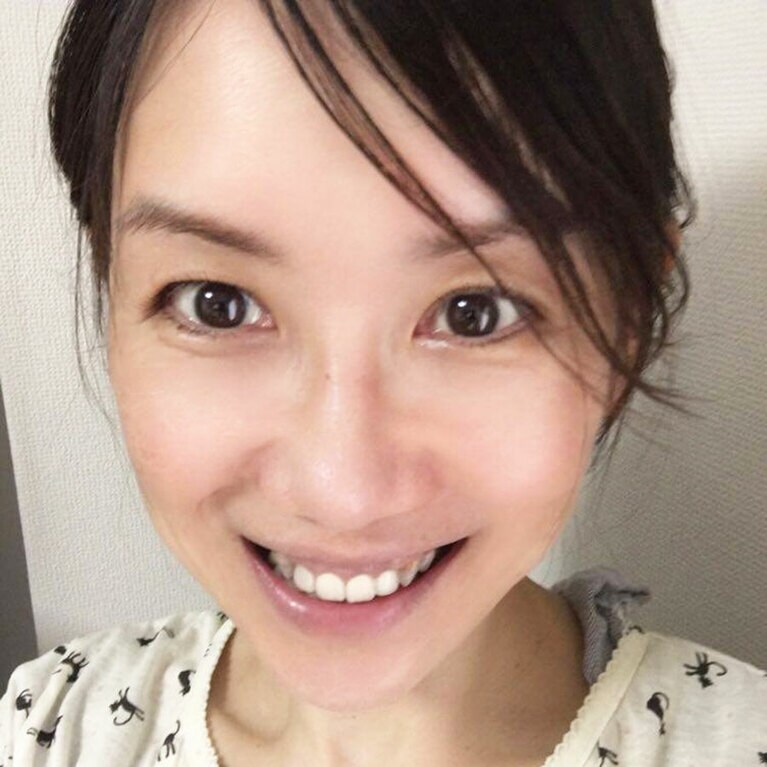 こちらが一週間後です。唇の可動域が広がったので、口角を上げた笑顔が作れるようになりました！