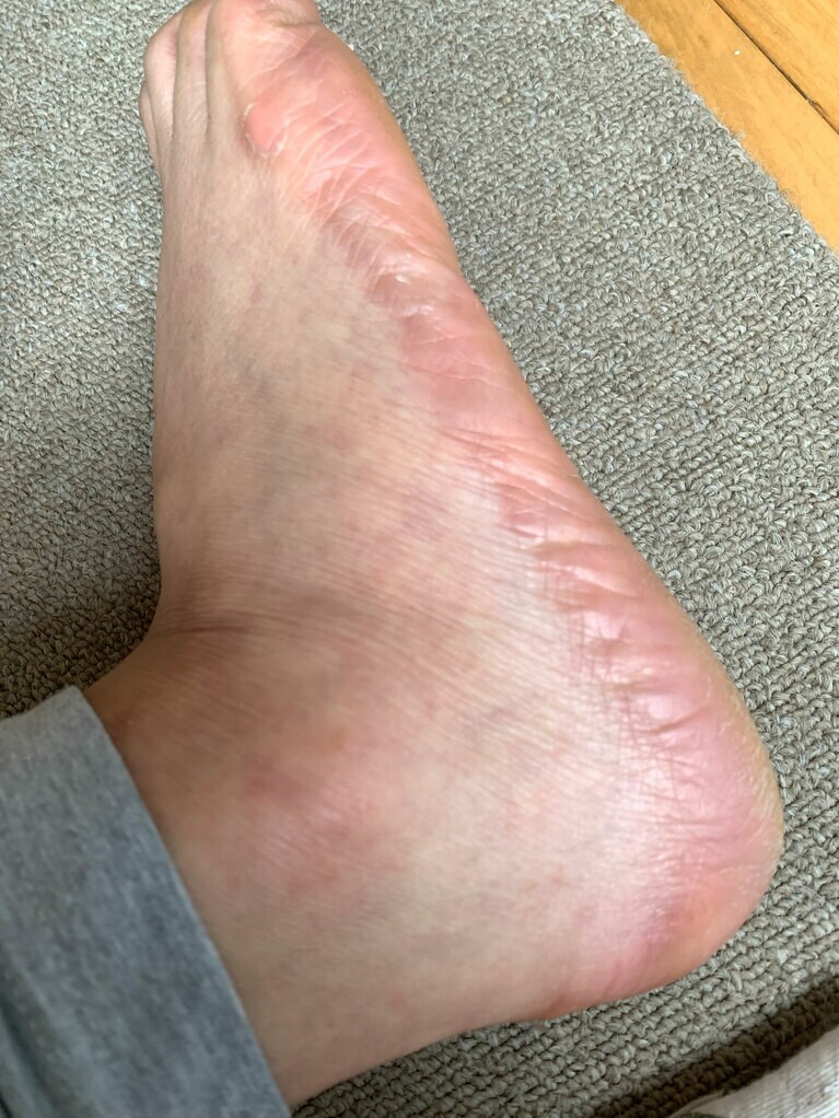 足裏の皮膚炎。見た目は赤くなるだけだが、お湯に浸かると激痛が走った。