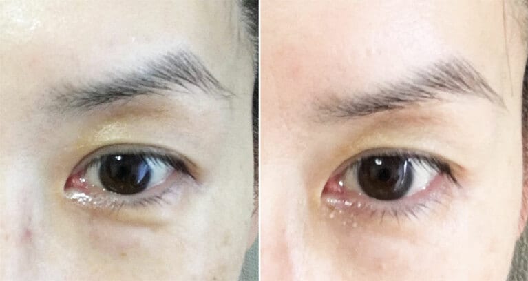 左は、凹んで早々の頃。シミとくすみも急激増加です……。右は、ケアをスタートして数日後。諸々、多少は和らいだような。なお、目頭付近のポツポツは、ぽろぽろ取れたクリームです。紛らわしくてすみません。