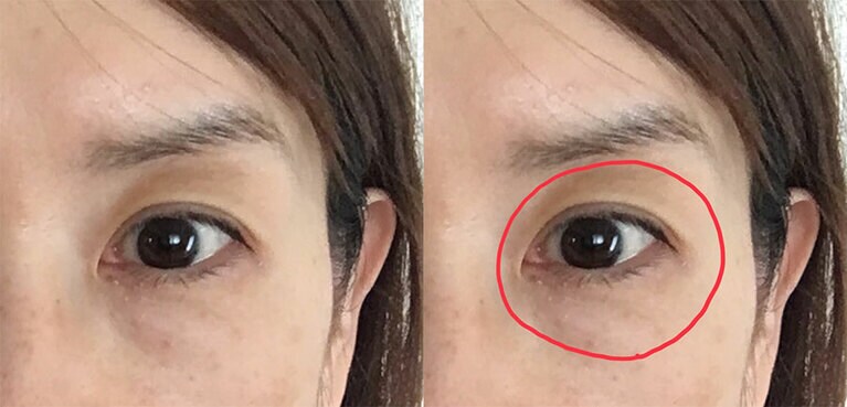 ノーメイクのビフォーです。丸で囲った部分がごそっと凹んでしまったのが悩みです。