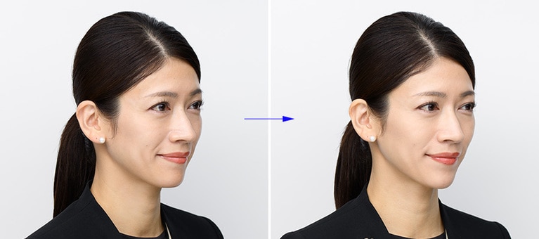 横顔での比較。頬や小鼻などの毛穴をカバーしながら、立体感は自然とアップ。