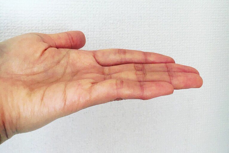 2日後には相当改善しました。