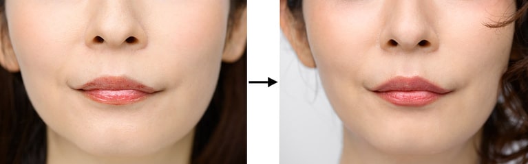 写真左から、BERORE画像、AFTER画像。