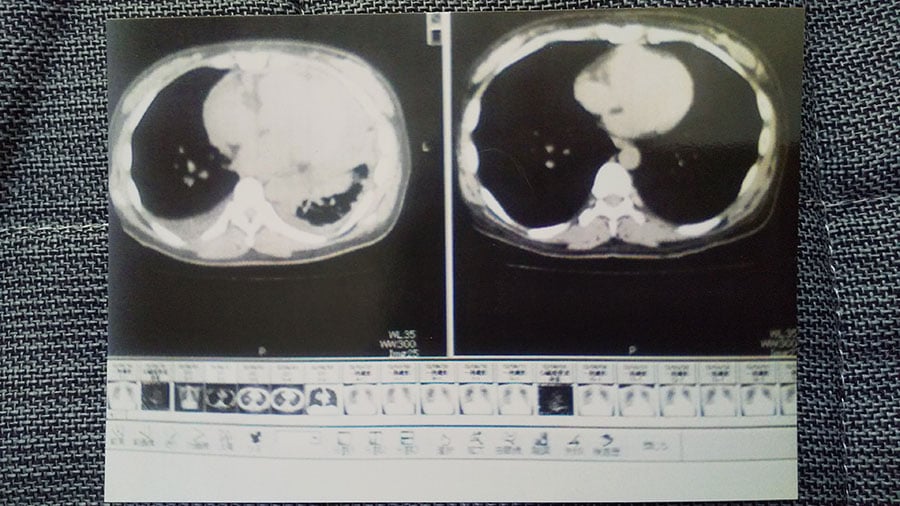 左側が入院時の後藤さんのCT画像。右側は入院して半年後、回復した状態のもの。心臓と心膜の間に心嚢液が溜まり、心臓が大きくなっていた。肺には胸水も。（後藤さん提供）