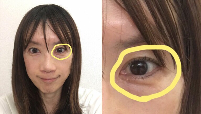 私の悩み箇所を黄色で囲みました。大きく凹んでいて色クマもあります……。